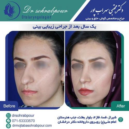 جراحی بینی در شیراز 103