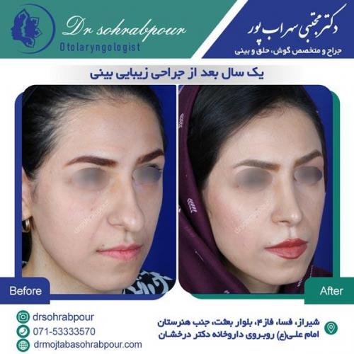 جراحی بینی در شیراز 104