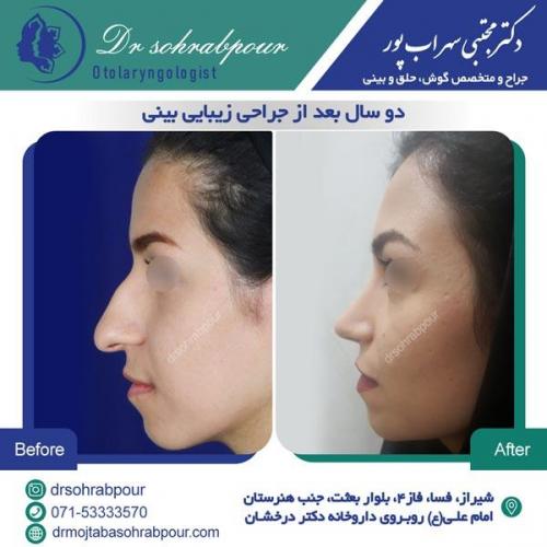 جراحی بینی در شیراز 105