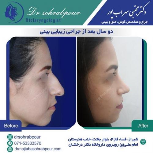جراحی بینی در شیراز 106