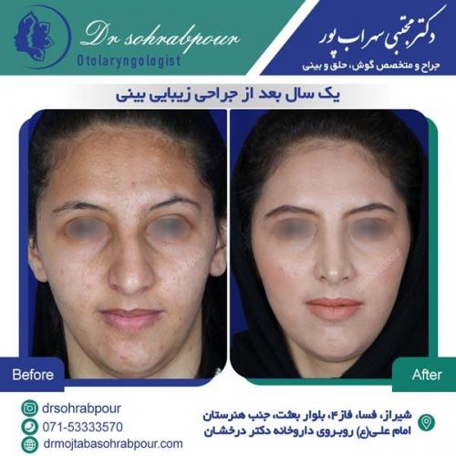 جراحی بینی در شیراز 108