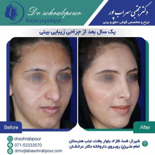 جراحی بینی در شیراز 109