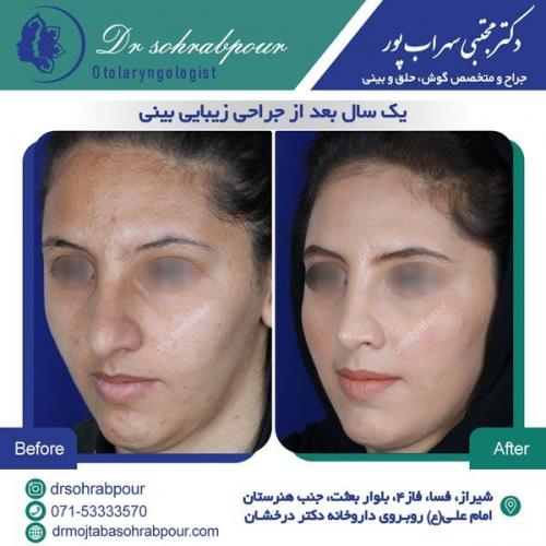 جراحی بینی در شیراز 110