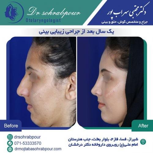 جراحی بینی در شیراز 111