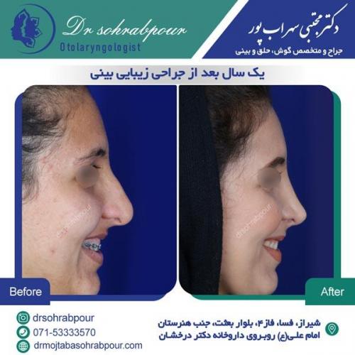 جراحی بینی در شیراز 112