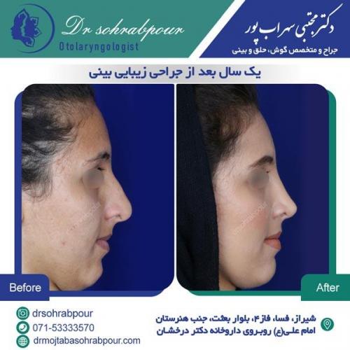جراحی بینی در شیراز 113