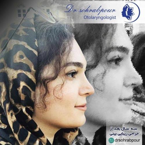 جراحی بینی در شیراز 114
