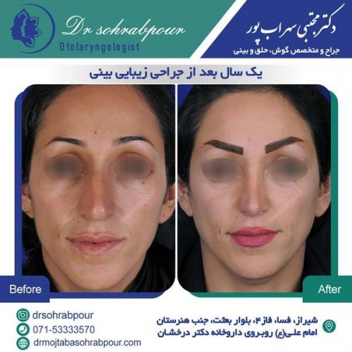 جراحی بینی در شیراز 115