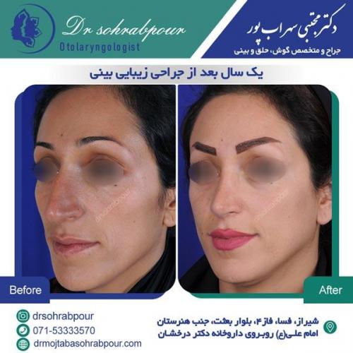 جراحی بینی در شیراز 116