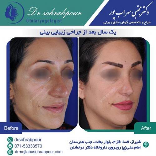 جراحی بینی در شیراز 117