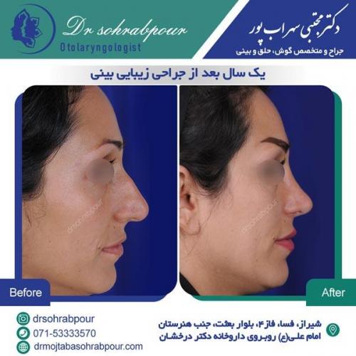 جراحی بینی در شیراز 118