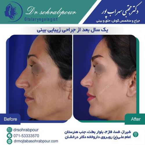 جراحی بینی در شیراز 120