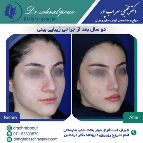 جراحی بینی در شیراز 125