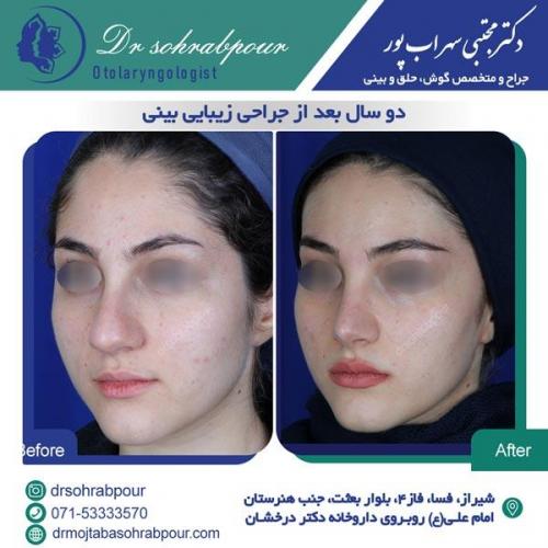 جراحی بینی در شیراز 126
