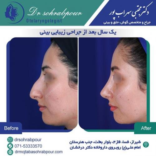 جراحی بینی در شیراز 127