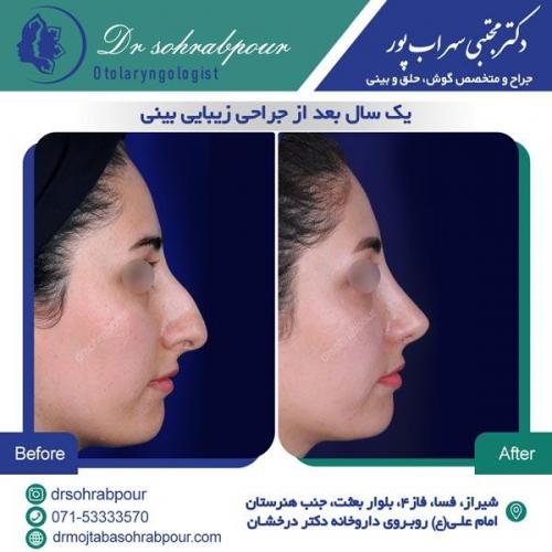 جراحی بینی در شیراز 128