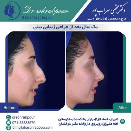 جراحی بینی در شیراز 129