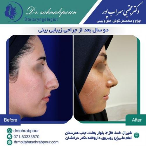 جراحی بینی در شیراز 130