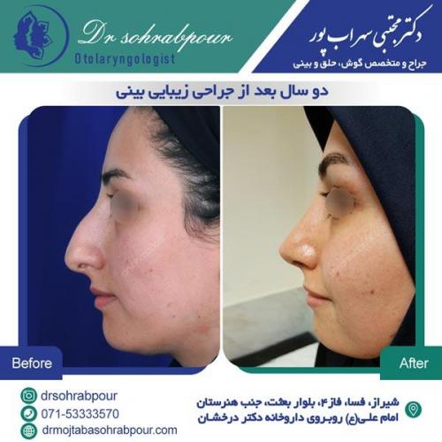 جراحی بینی در شیراز 131