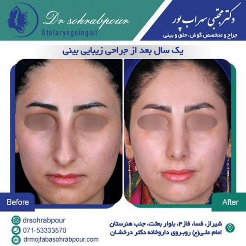 جراحی بینی در شیراز 132
