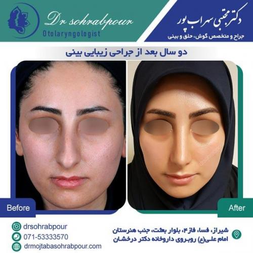 جراحی بینی در شیراز 133