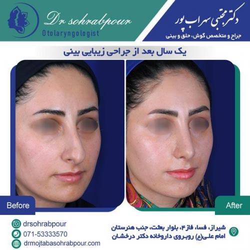 جراحی بینی در شیراز 134