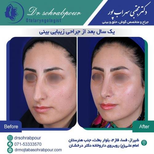 جراحی بینی در شیراز 135