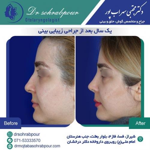 جراحی بینی در شیراز 136