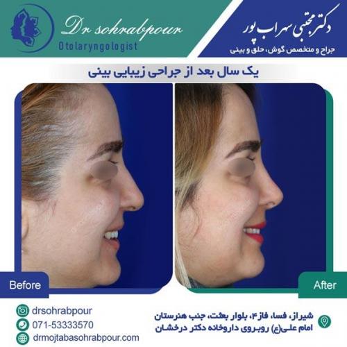 جراحی بینی در شیراز 137