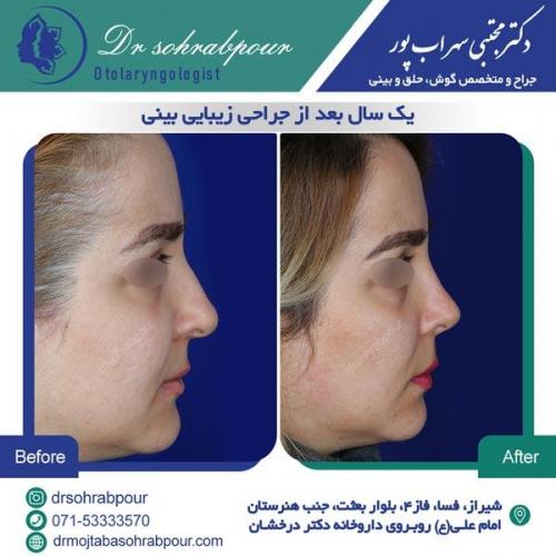 جراحی بینی در شیراز 138