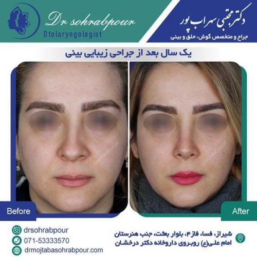 جراحی بینی در شیراز 139