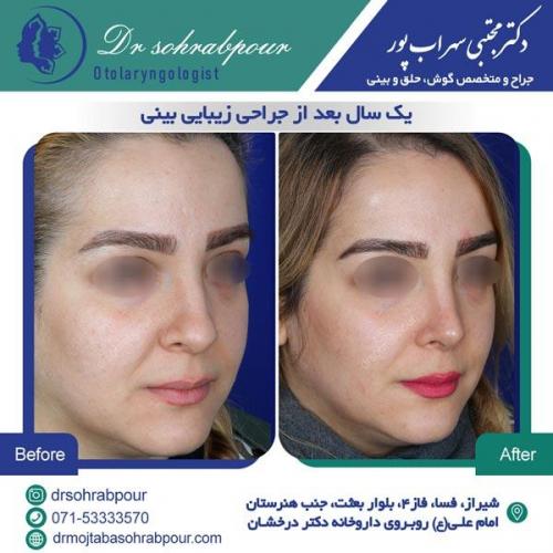 جراحی بینی در شیراز 140