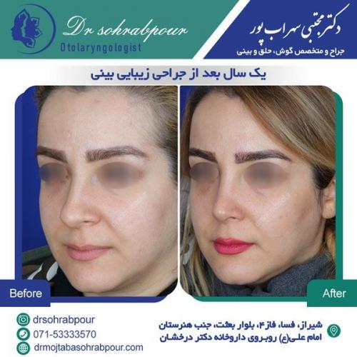 جراحی بینی در شیراز 141