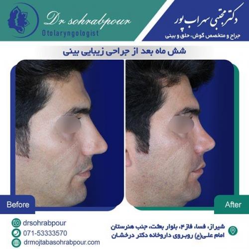 جراحی بینی در شیراز 142