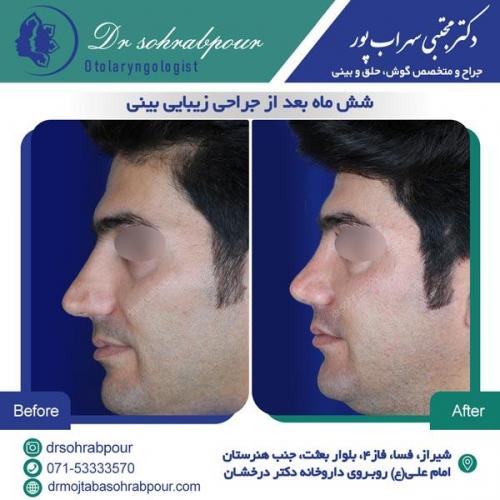 جراحی بینی در شیراز 143
