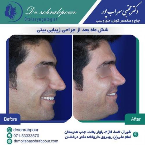 جراحی بینی در شیراز 144