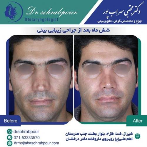جراحی بینی در شیراز 145