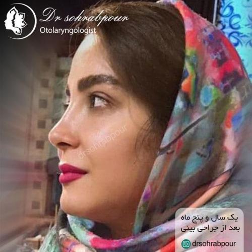 جراحی بینی در شیراز 146