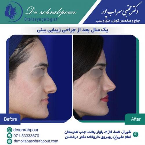 جراحی بینی در شیراز 147