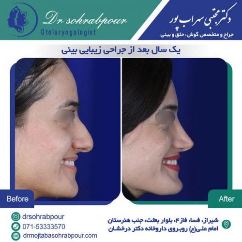 جراحی بینی در شیراز 148
