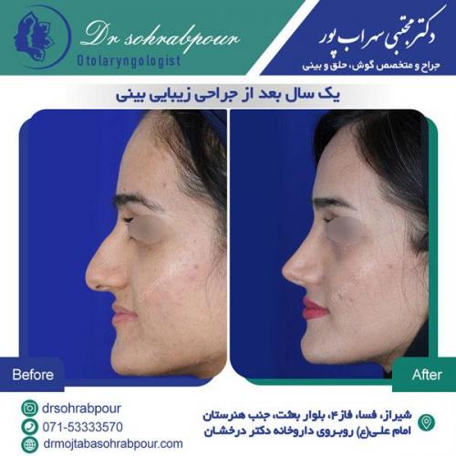 جراحی بینی در شیراز 149