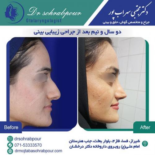 جراحی بینی در شیراز 150