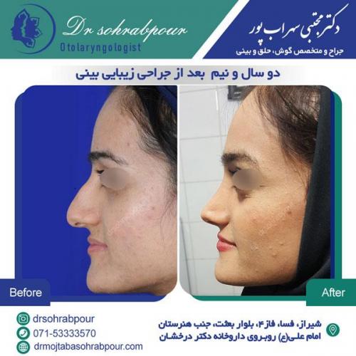 جراحی بینی در شیراز 151