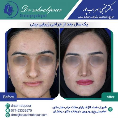 جراحی بینی در شیراز 152