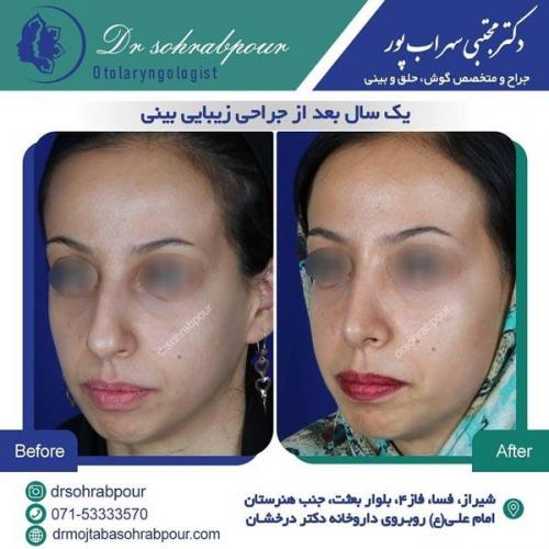 جراحی بینی در شیراز 16