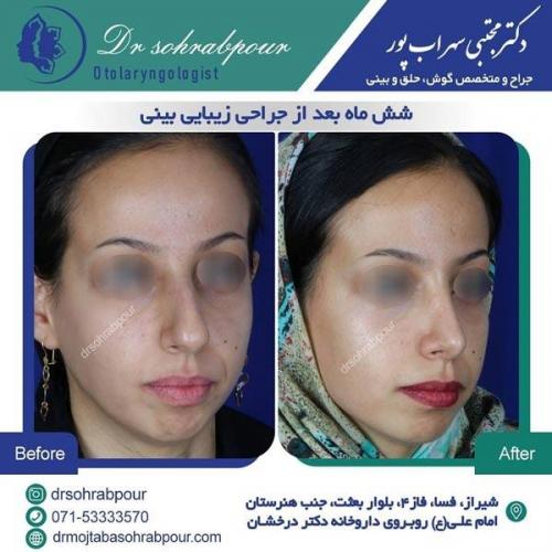 جراحی بینی در شیراز 18