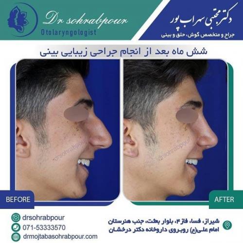 جراحی بینی در شیراز 2