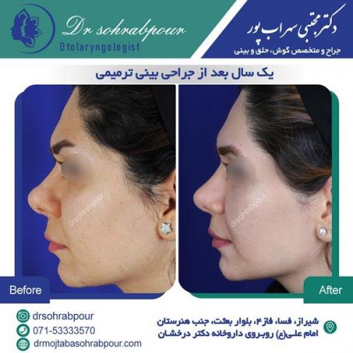 جراحی بینی در شیراز 20