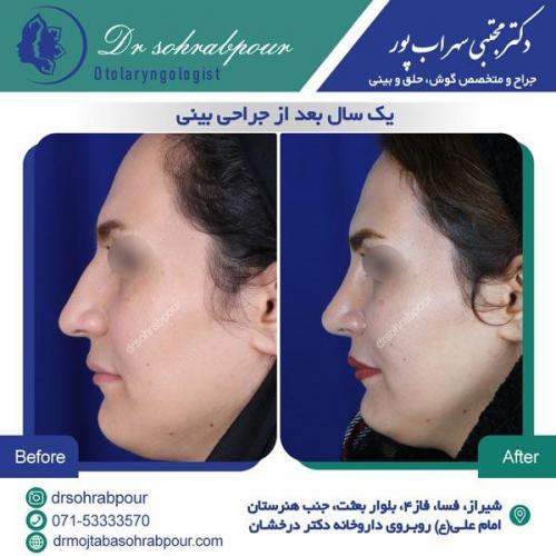 جراحی بینی در شیراز 27