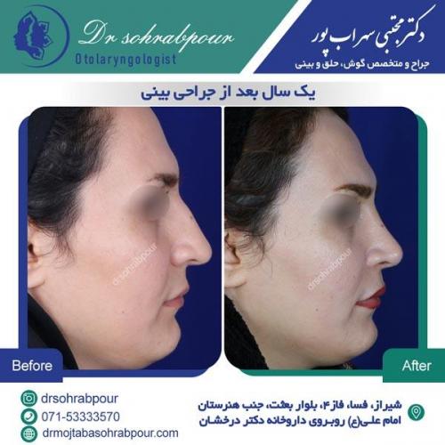 جراحی بینی در شیراز 28